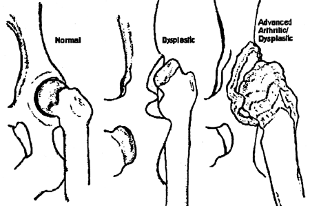 GIF file showing normal and dysplastic  hips.